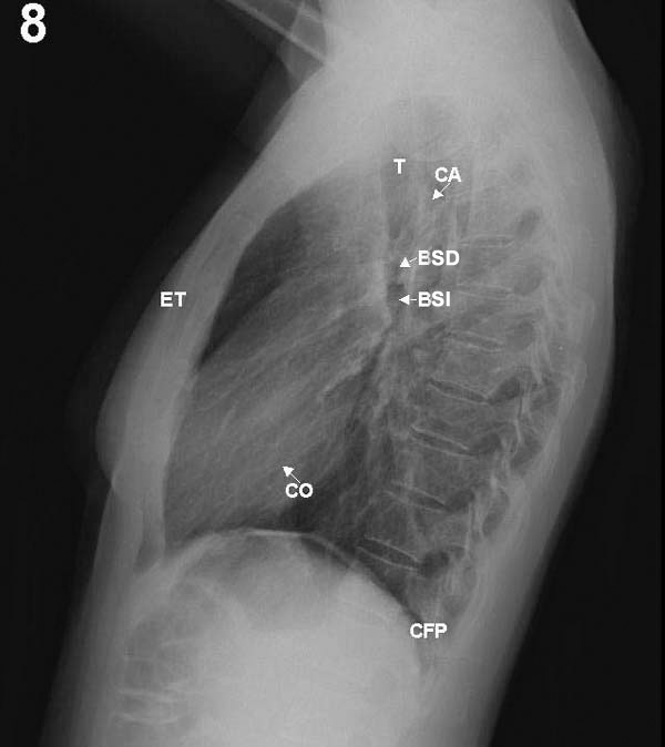 Radiografia De Torax Lateral Normal